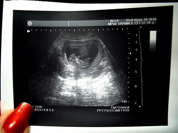 снимки узи на 11 неделе беременности. узи 10-11 недель беременности. 11 недель беременности фото плода на узи. плод на 11 неделе беременности узи. ребенок 11 недель беременности узи.