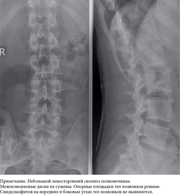 Спондилит поясничного отдела позвоночника рентген. Спондилит поясничного отдела рентген. Рентген здорового позвоночника сбоку. Ювенильный анкилозирующий спондилит. Рентгенография позвоночника в 2 х проекциях
