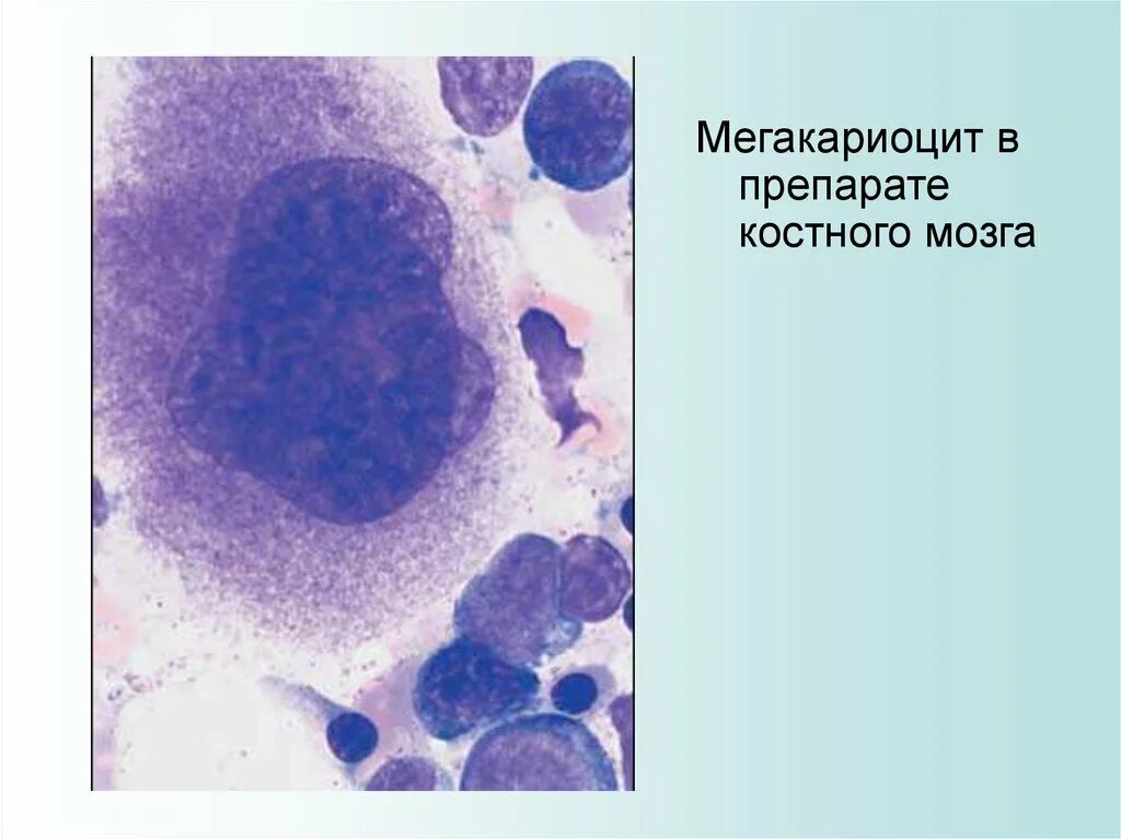 Мегакариоциты красного мозга. Мегакариоциты красного мозга. Тромбоцитопеническая пурпура костный мозг. Цитология костного мозга. Тромбоциты мегакариоциты.