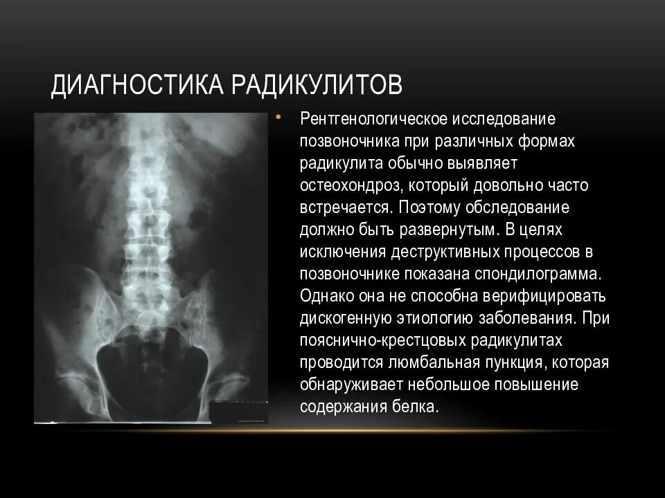 Симптомы поясничной радикулопатии. Диагностика радикулита. Радикулит презентация. Пояснично-крестцовой радикулопатии.