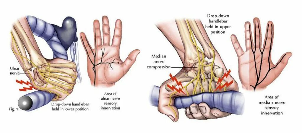 Онемение пальцев после операции. Туннельный синдром велосипедиста. Туннельный синдром лучевого нерва. Сдавление срединного нерва.