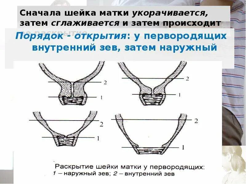 Что значит зев закрыт. Раскрытие шейки матки у первородящих. Раскрытие внутреннего зева. Раскрытие шейки у первородящей.