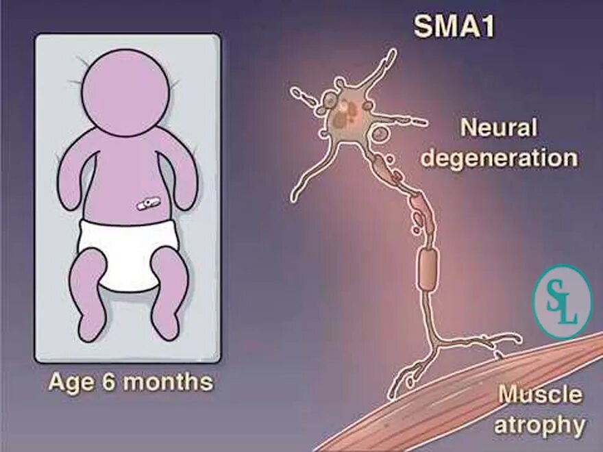Спинальная мышечная атрофия (СМА). Спиналное мышичное арофия. Спинальная мышечная атрофия этиология. Спинально-мышечная атрофия симптомы.