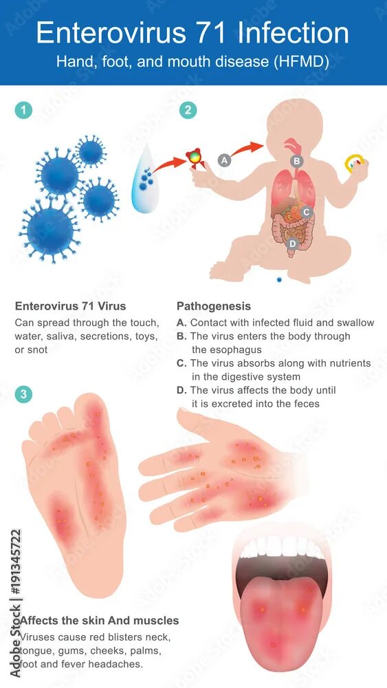 El Virus Coxsackie - Steemit