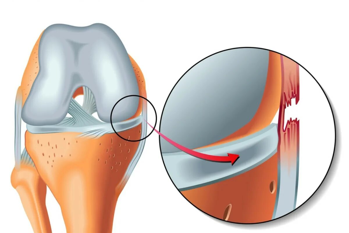Повреждение связок мениска. Повреждение медиальной коллатеральной связки. Растяжение мениска сустава.