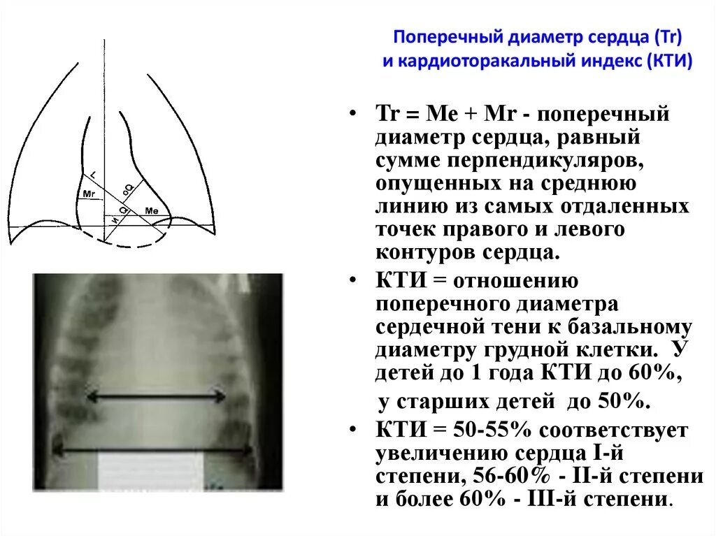 КТИ норма в рентгене у взрослого. КТИ рентген норма сердце. Как измерить КТИ рентген. КТИ норма в рентгене. Длинник и поперечник