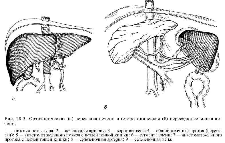 Пересаживают ли печень. Гетеротопическая пересадка печени. Ортотопическая и Гетеротопическая трансплантация печени. Техника ортотопической трансплантации печени. Ортотопическая пересадка печени.