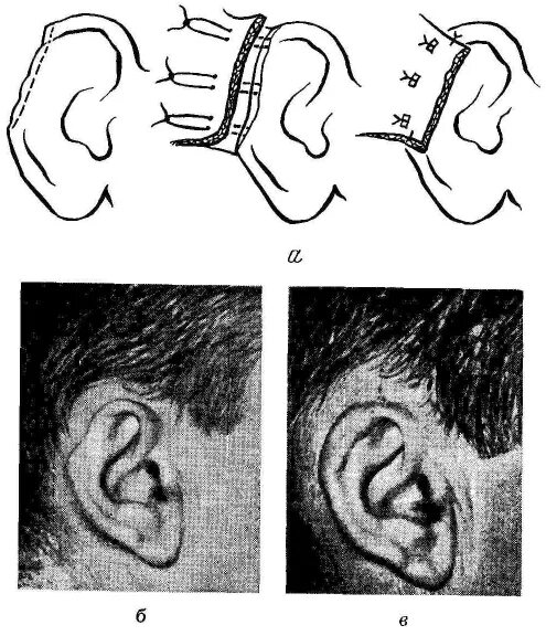 Деформация ушной раковины. Радикальная операция на ухо. Деформация завитка уха. При Радикальной операции на среднем ухе. Операция на среднем ухе