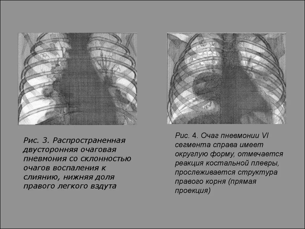 Очаги в нижней доле легкого. Осложнения двусторонней очаговой пневмонии. Двусторонняя очаговая пневмония. Двухстороняя пневмония. Двухсторонняя очаговая пневмония.