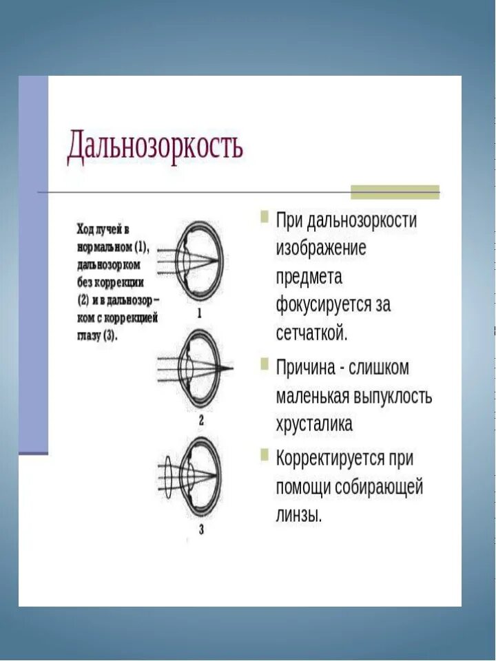 При дальнозоркости изображение предмета фокусируется. Дальнозоркость. при дальнозоркости. дальнозоркость ход лучей. изображение при дальнозоркости.
