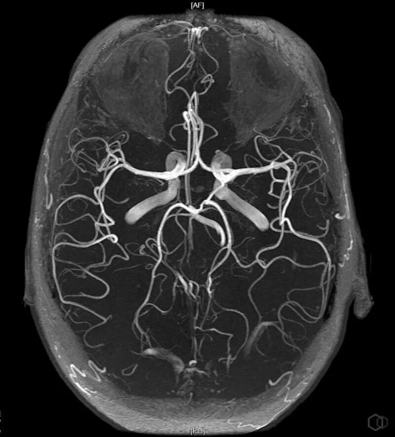 Артерии круг головного мозга. Мрт ангиография сосудов головного. МР-ангиография сосудов головного мозга анатомия. Виллизиев круг ангиография. Мрт головного мозга с ангиографией.