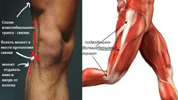 Боль под коленом спереди. Синдром илиотибиального тракта. Синдром бегуна колено илиотибиального тракта. Подвздошно большеберцовый тракт. Тянет мышцу бедра сбоку.