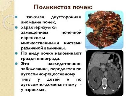 Множественные обеих почек