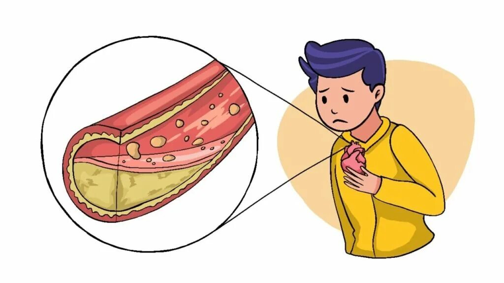 Атеросклероз картинки. Девочки мальчики сосуда