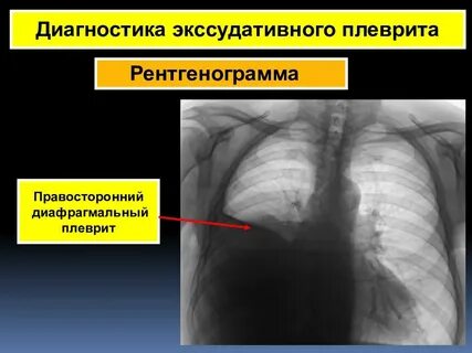 Правосторонний плеврит