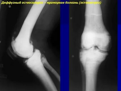 Врожденные заболевания костей