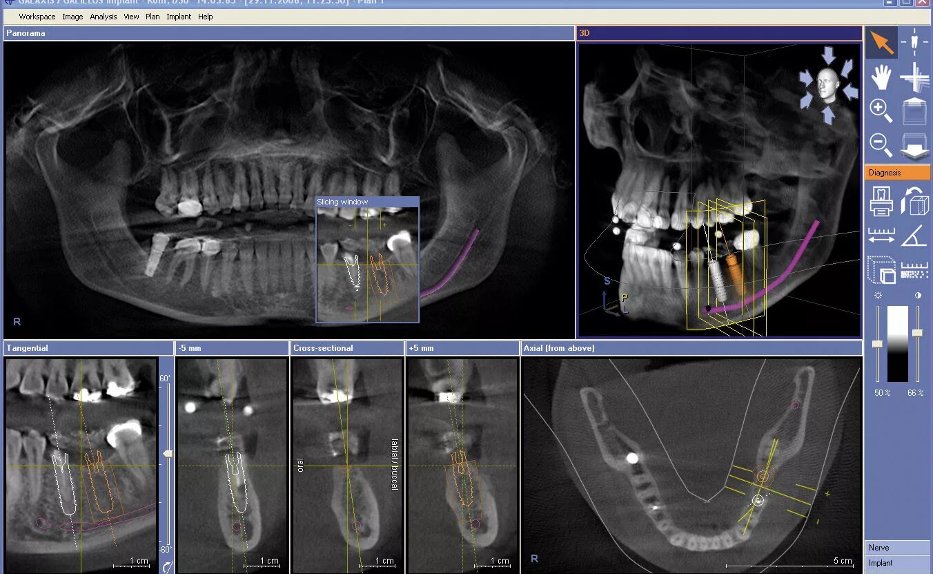 Имплант и мрт можно ли. Компьютерная томография 2 челюсти. Кт 3д зубочелюстной системы.