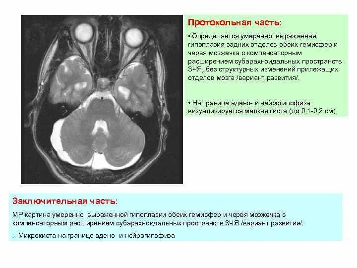 Гипоплазия червя. Гипоплазия червя мозжечка мрт. Аномалии развития мозжечка мрт. Гипоплазия червя мозжечка кт.