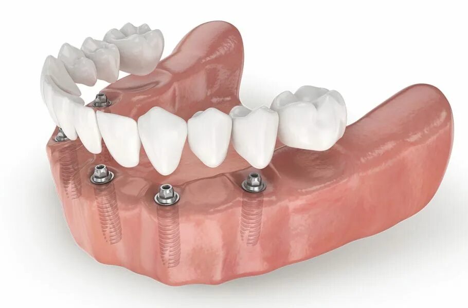 All on 6 цена. Несъёмный мостовидный протез челюсти. Имплантация челюсти на 6 имплантах. Имплантация челюсти на 4 имплантах.