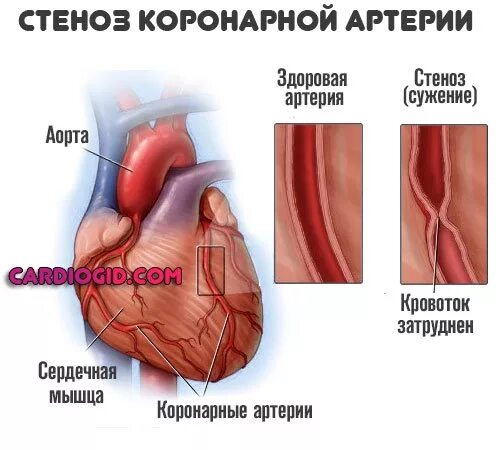 Сердечный стеноз. Коронарные артерии сужения корон. Спазм коронарных сосудов сердца симптомы. Спазм венечных артерий. Стеноз коронарных артерий.