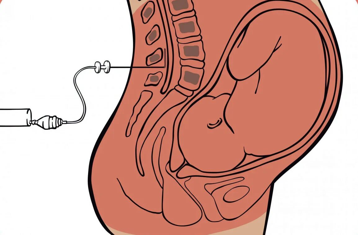 Спинномозговая анестезия (сма). Эпидуральная анестезия методы. Эпидуральная анальгезия. Апелупальеая анастазия. Эпидуральная анальгезия.