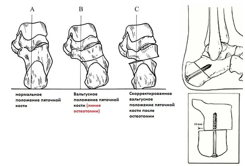 Операция пяточной кости. Плоскостопие вальгусная деформация. Вальгусная деформация пяточной кости рентген. Вальгусная деформация искривление стопы. Вальгусная деформация стопы классификация.