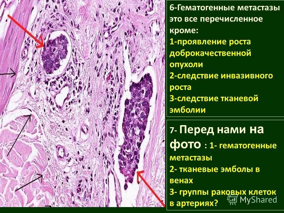 Гематогенный латынь. Метастазирование доброкачественной опухоли. Гематогенное метастазирование. Доброкачественная опухоль метастазы.