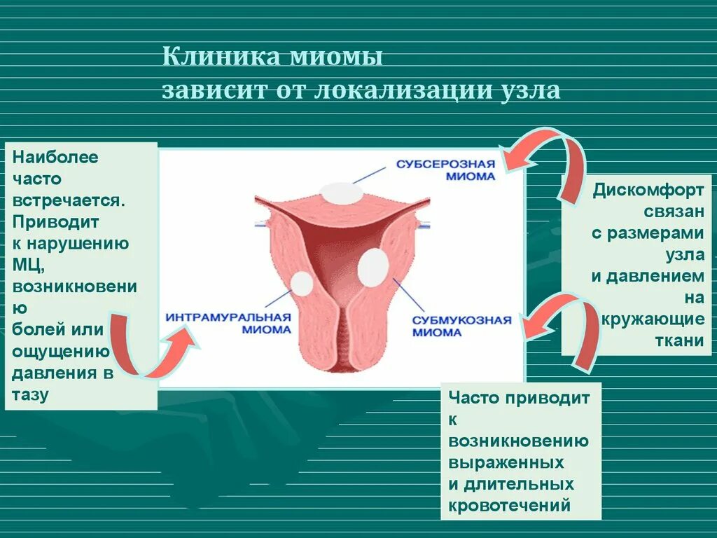 Миома матки симптомы и признаки. Клинические проявления лейомиомы матки. Локализация миомы матки.