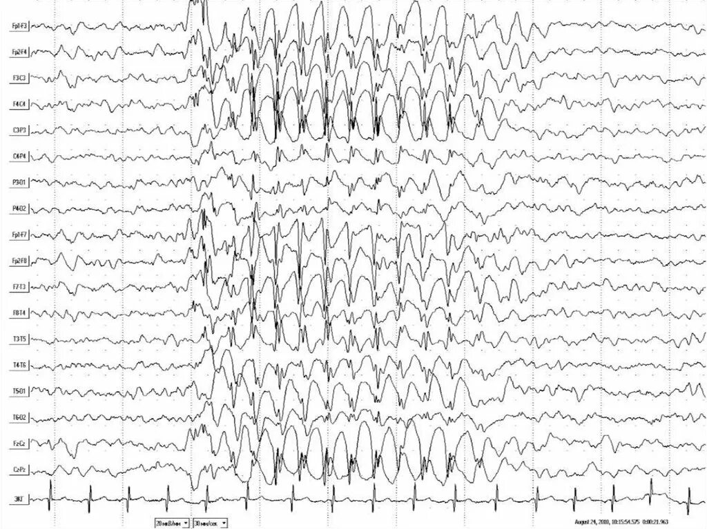 Детская абсансная эпилепсия. ЭЭГ головного мозга больного эпилепсией. ЭЭГ норма и эпилепсия. Эпилепсия на ЭЭГ. Детская абсансная эпилепсия на ЭЭГ.