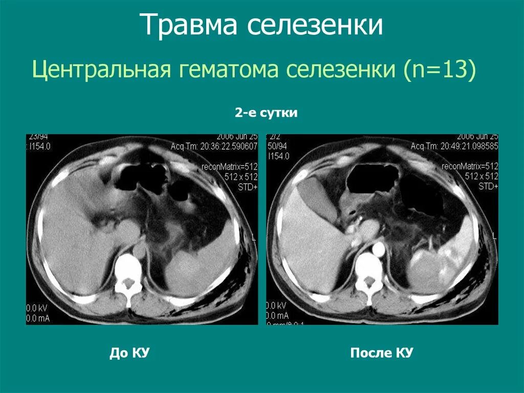 Гематома селезенки