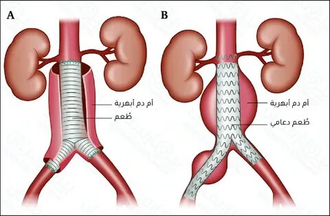 Abdominal aortic aneurysm