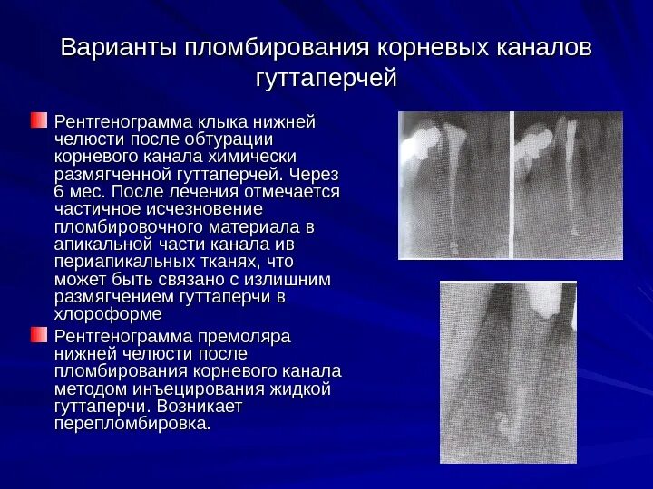 Методы пломбирования корневых. Система обтурации корневых каналов. Временная обтурация корневых каналов материалы. Метод пломбирования корневого канала по Бьюкенену. После обтурации корневого канала.