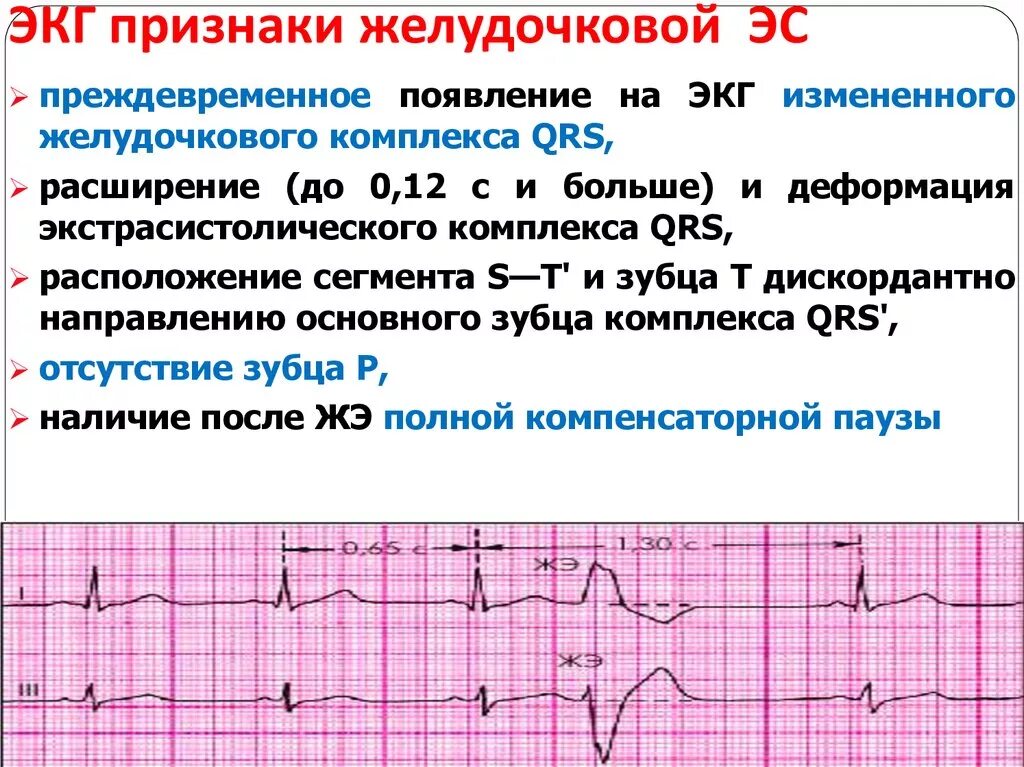 Отрицательный зубец р после QRS комплекса. Ось QRS норма ЭКГ. ЭКГ сердца QRS норма. ЭКГ кардиограмма в норме и с патологией. Экг со скольки