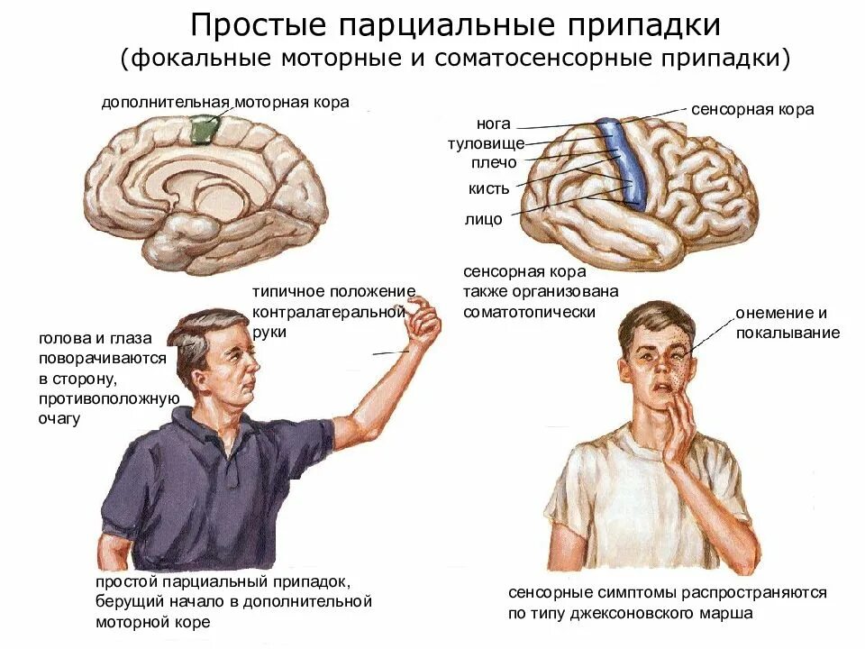 Поражение половины мозга. Простые парциальные припадки эпилепсии симптомы. Простые парциальные моторные припадки. Парциальные судорожные пароксизмы. Фокальные (парциальные) формы эпилепсии.