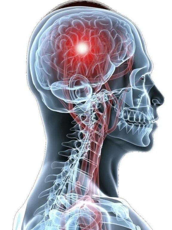 Неврология мозг. Эпилепсия головной мозг.