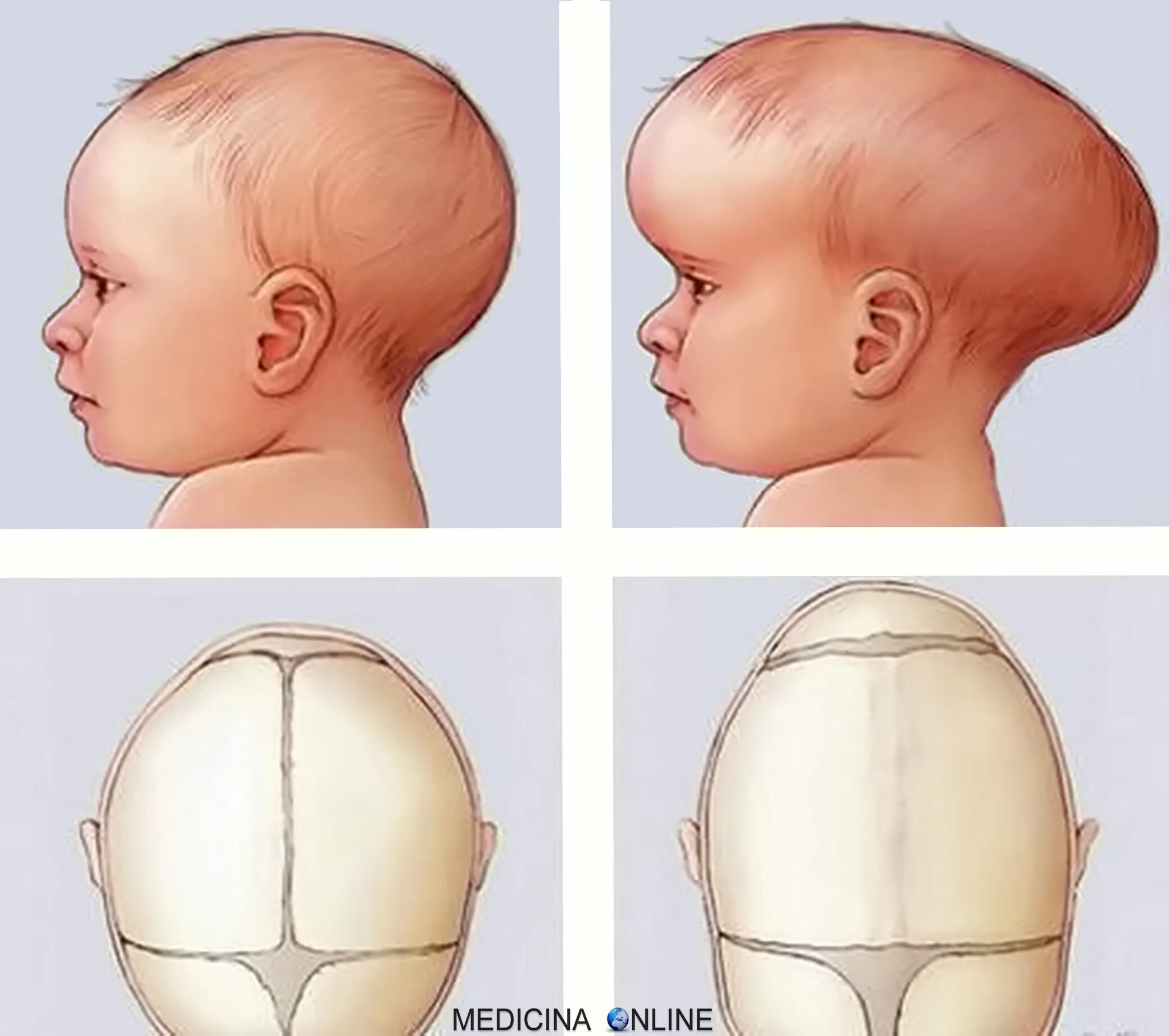 Выпуклый родничок. Долихолическая форма головы у плода. Долихоцефалическая форма головы новорожденного. Долихоцефалия черепа плода. Форма черепа у грудничка норма.