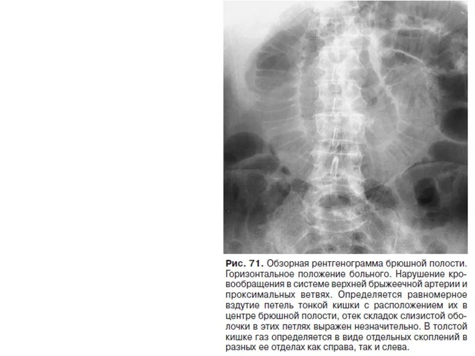 Раздутые петли Толстого кишечника рентген. Обзорный снимок брюшной полости рентген. Петли кишечника на рентгене. Расширенные петли кишечника. Расширение петель кишечника
