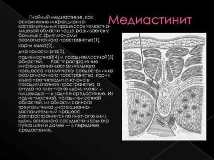 Медиастенит