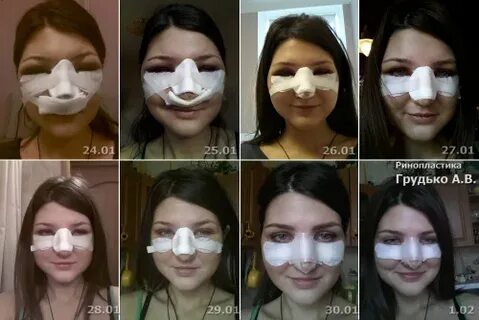 Через сколько можно делать повторную операцию