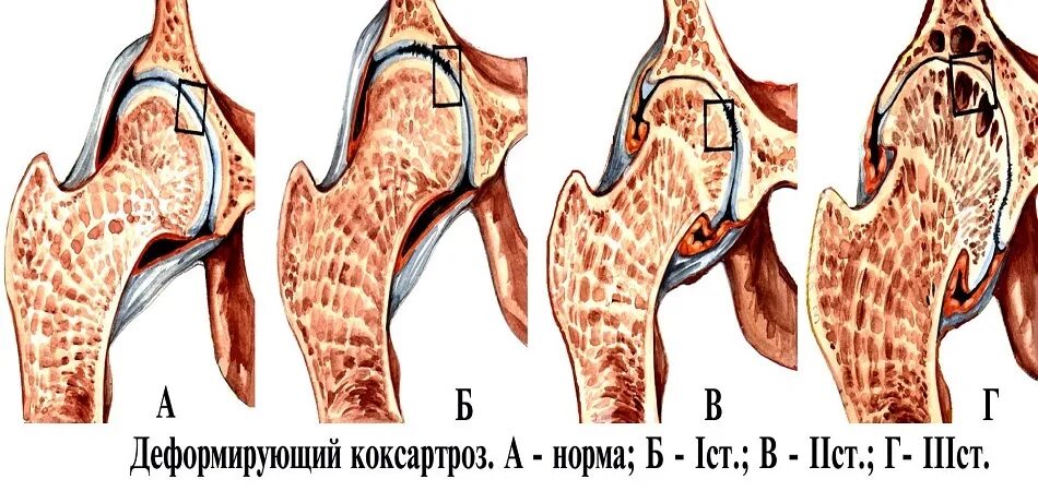 Деформирующий артроз тазобедренного сустава 1 степени. Деформирующий коксартроз тазобедренного сустава. Коксартроз тазобедренного сустава 3. Деформирующий коксартроз 3 степени.