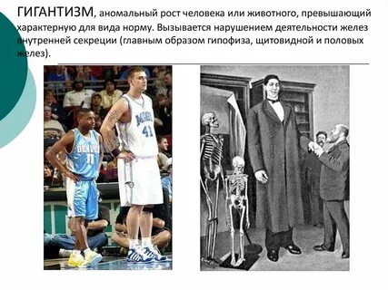 Гигантизм сахарный диабет