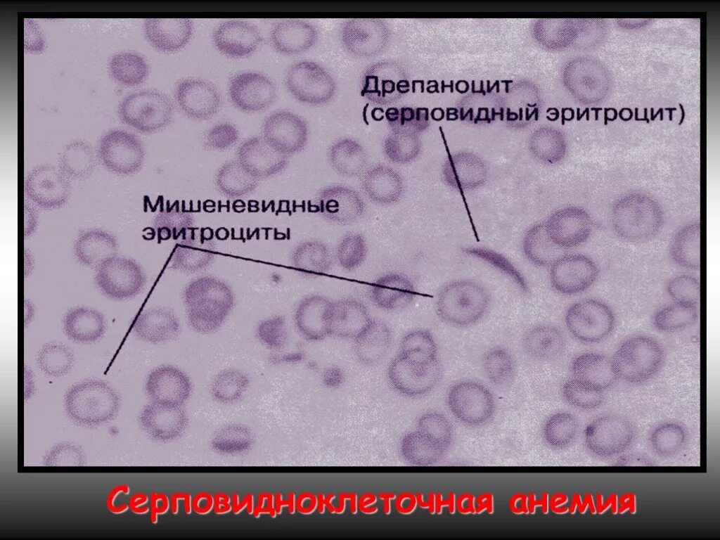 Серповидные эритроциты. Серповидноклеточная анемия мазок крови. серповидноклеточная анемия эритроциты. картина крови при серповидноклеточной анемии. серповидноклеточная анемия микроскопия.