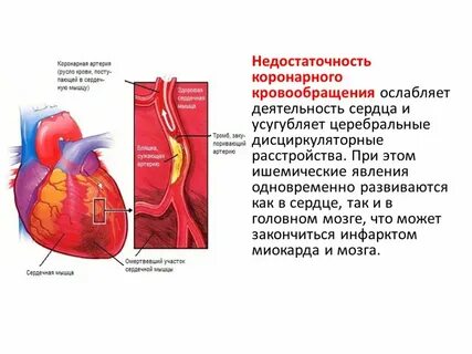 Спазм сердечных сосудов
