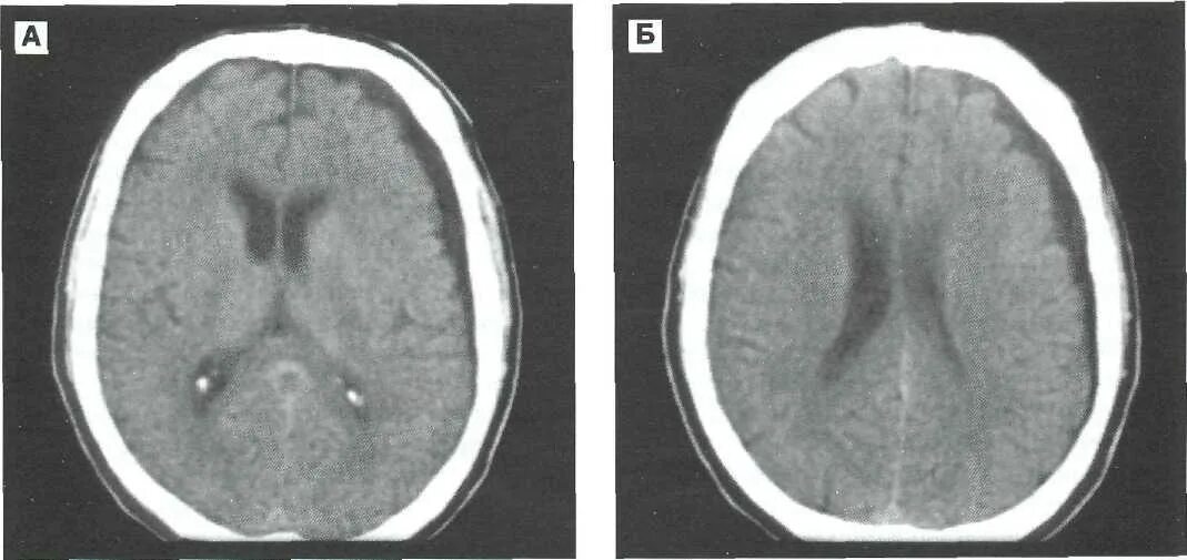 Субдуральная гидрома кт. Подострая субдуральная гематома на кт. Субдуральная гигрома мрт. Субдуральная гематома головного мозга кт. Гематома мозга операция