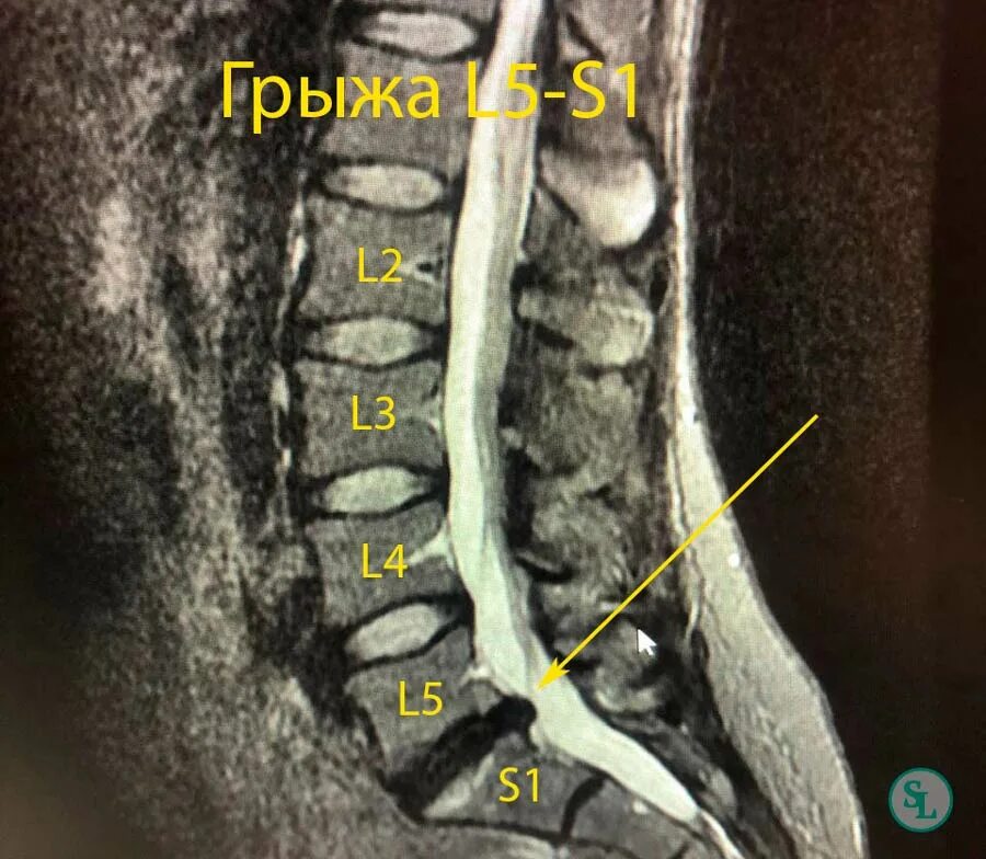 Грыжа диска l5 s1 что это. Диски l5-s1 в позвоночнике. Диски l4 s1 позвоночника. Межпозвонковый диск l5-s1. Грыжи дисков l1 l2 l3 l4 l5 s1.