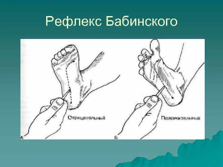 Положительные рефлексы. Подошвенный рефлекс Бабинского. Разгибательный рефлекс Бабинского. Патологический стопный рефлекс Бабинского. Рефлекс Бабинского у детей.