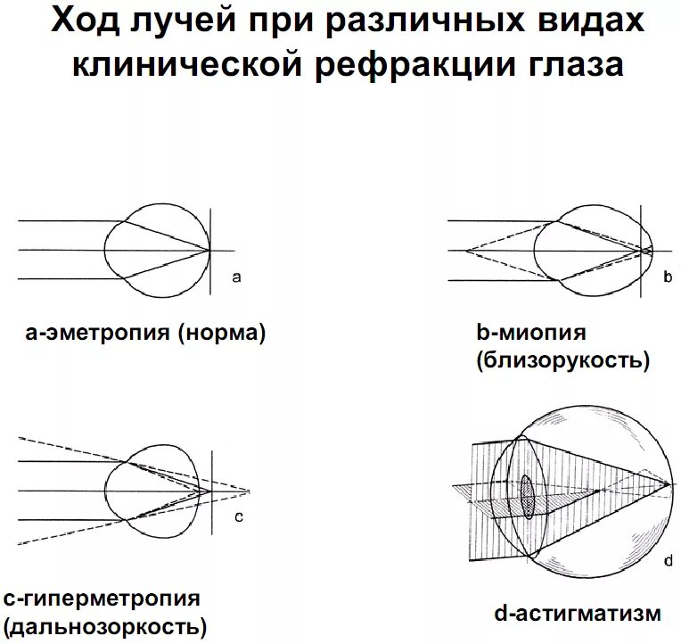 Ход лучей глаза человека. Астигматизм схема преломления лучей. Схема хода световых лучей в глазу при близорукости. Схема ход световых лучей при астигматизме. Ход лучей при разных видах рефракции.