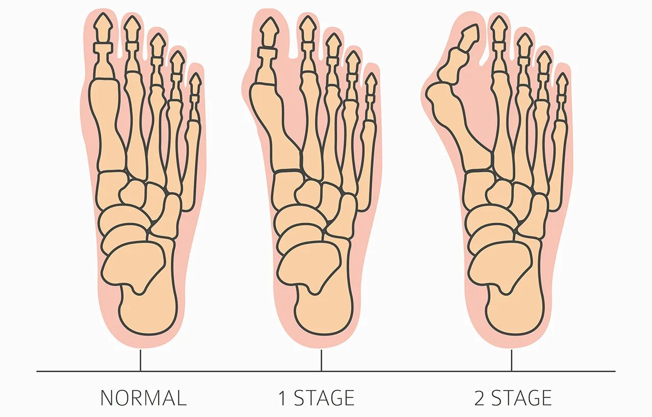 Normal feet