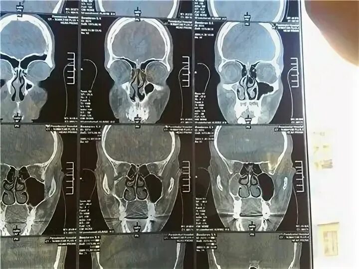 киста пазухи носа мкб