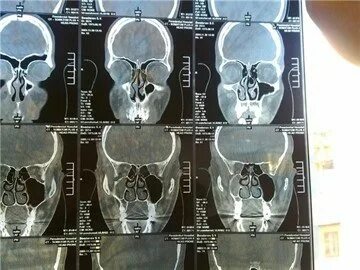 Киста верхнечелюстной пазухи размеры